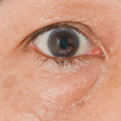 eyebag_symptom